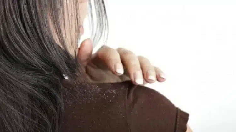 فوائد زيت جوز الهند للشعر