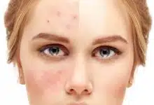 تأثير النفسية علي صحة الجلد